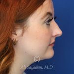 before rhinoplasty right side view of female patient 21519