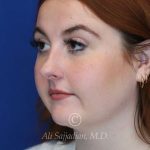 before rhinoplasty left angle view of female patient 21519