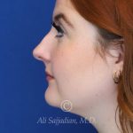 before rhinoplasty left side view of female patient 21519