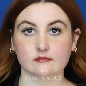after rhinoplasty front view of female patient 21519