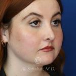 after rhinoplasty right angle view of female patient 21519