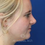 after rhinoplasty right side view of female patient 21531