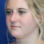 after rhinoplasty left angle view of female patient 21531