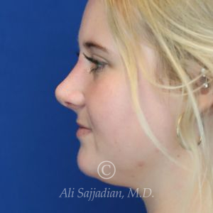 after rhinoplasty left side view of female patient 21531