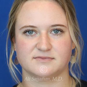 before rhinoplasty front view of female patient 21531