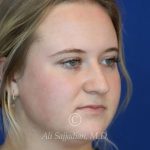 before rhinoplasty right angle view of female patient 21531