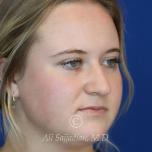 before rhinoplasty right angle view of female patient 21531