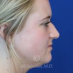 before rhinoplasty right side view of female patient 21531