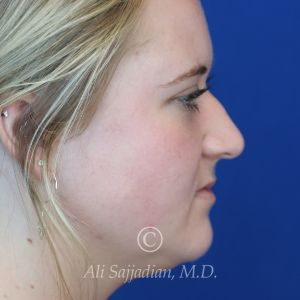 before rhinoplasty right side view of female patient 21531