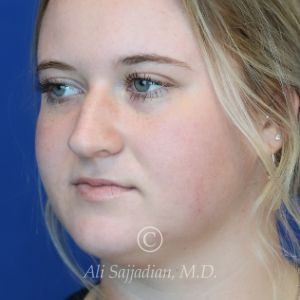 before rhinoplasty left angle view of female patient 21531