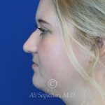 before rhinoplasty left side view of female patient 21531