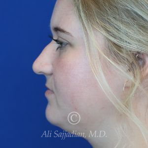 before rhinoplasty left side view of female patient 21531