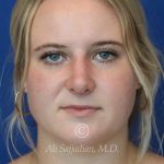 after rhinoplasty front view of female patient 21531