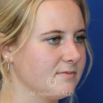 after rhinoplasty right angle view of female patient 21531