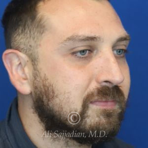 after rhinoplasty right angle view of male patient 21543