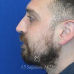 after rhinoplasty left side view of male patient 21543