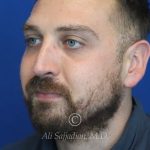 after rhinoplasty left angle view of male patient 21543
