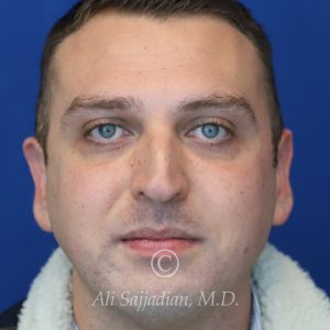 after rhinoplasty front view of male patient 21543
