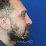 after rhinoplasty right side view of male patient 21543