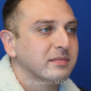 before rhinoplasty right angle view of male patient 21543