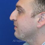 before rhinoplasty left side view of male patient 21543