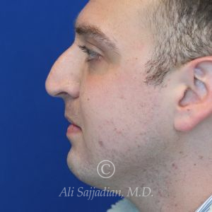 before rhinoplasty left side view of male patient 21543