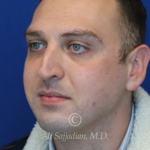 before rhinoplasty left angle view of male patient 21543
