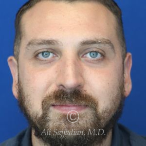 after rhinoplasty front view of male patient 21543