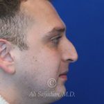before rhinoplasty right side view of male patient 21543