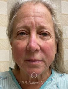 before brow lift front view of female patient 21706