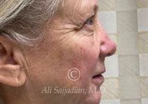 before eyelid surgery left side view of female patient 21715