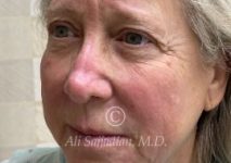 before eyelid surgery left angle view of female patient 21715