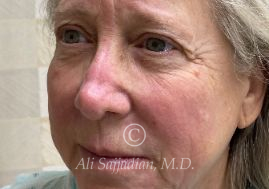 before eyelid surgery left angle view of female patient 21715
