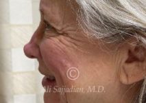 before eyelid surgery left side view of female patient 21715