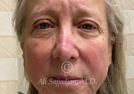 before eyelid surgery front view of female patient 21715