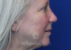 after eyelid surgery right side view of female patient 21715