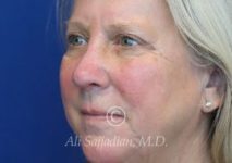 after eyelid surgery left angle view of female patient 21715