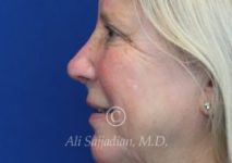 after eyelid surgery left side view of female patient 21715