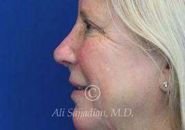 after eyelid surgery left side view of female patient 21715