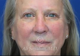after eyelid surgery front view of female patient 21715
