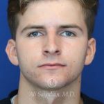 before rhinoplasty front view of male patient 21640