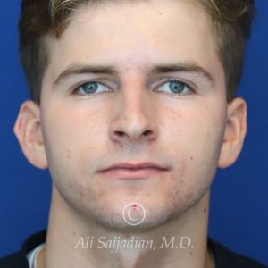 before rhinoplasty front view of male patient 21640