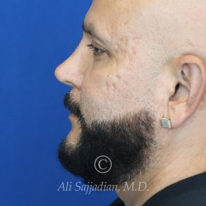 before male rhinoplasty left side view of patient 21756