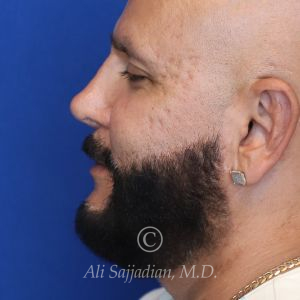 after male rhinoplasty right side view of patient 21756