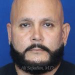 before male rhinoplasty front view of patient 21756