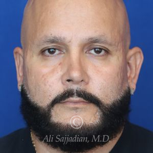 before male rhinoplasty front view of patient 21756