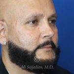 before male rhinoplasty right angle view of patient 21756