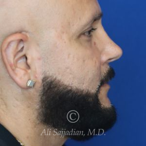before male rhinoplasty right side view of patient 21756
