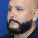before male rhinoplasty left angle view of patient 21756