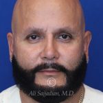 after male rhinoplasty front view of patient 21756